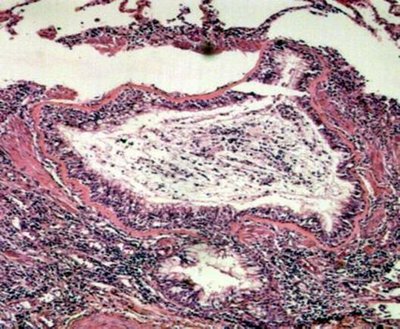bolile_respiratorii_cronice_2