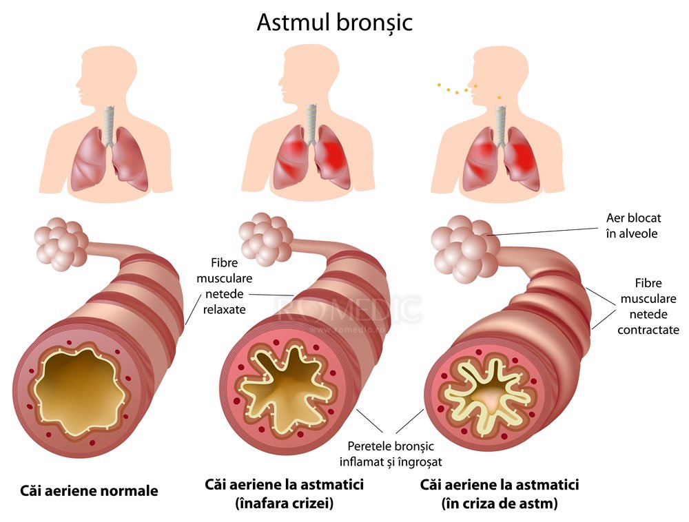 bolile_respiratorii_cronice_3