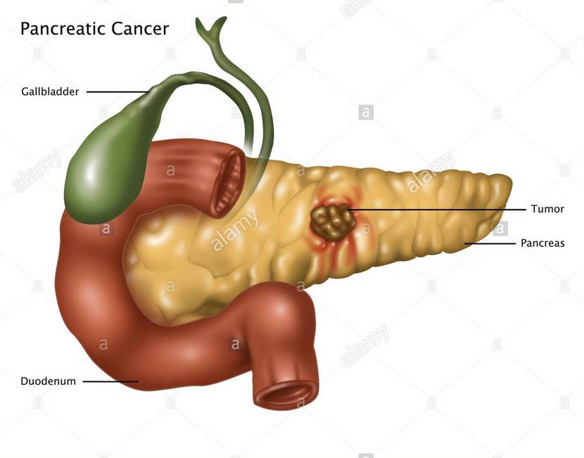 cancerul_pancreasului_01