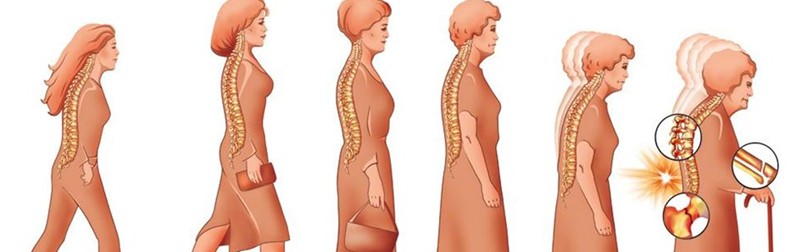 Menopauza_si_osteoporoza_2