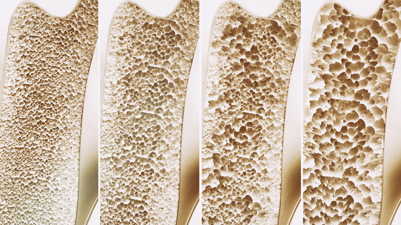 Menopauza_si_osteoporoza_4