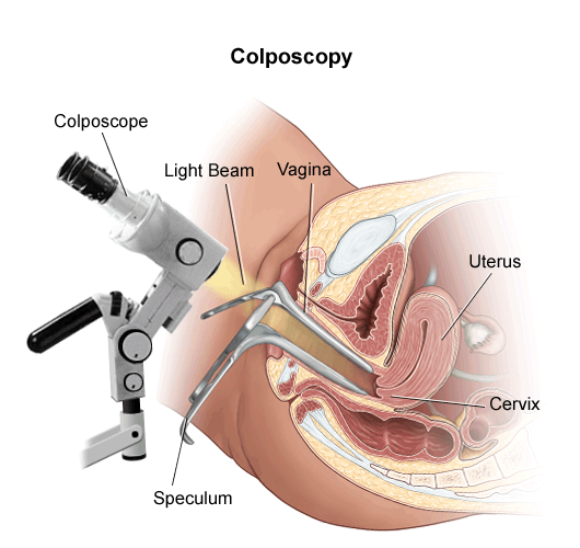 colposcopy_1